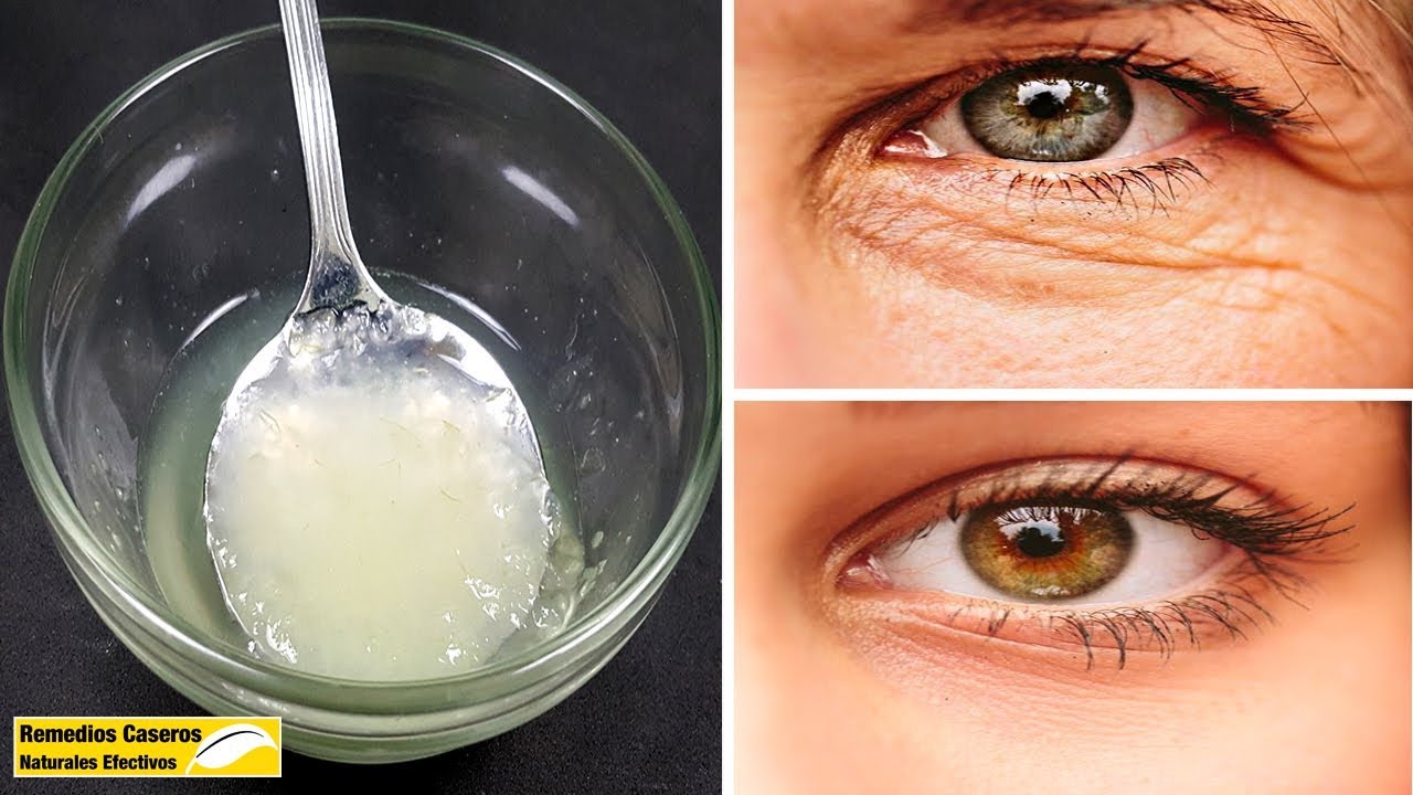 remedios caseros para eliminar las arrugas debajo de los ojos