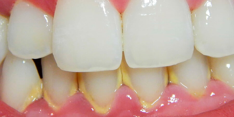 primer plano de dentadura con sarro en la parte inferior