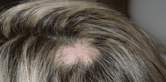 caida de cabello por estres