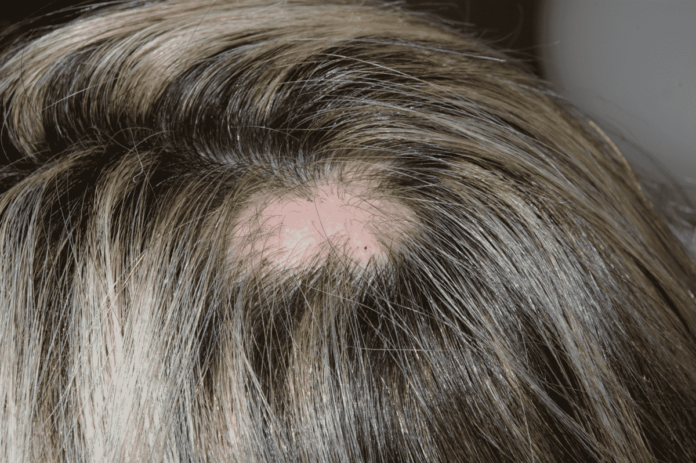 caida de cabello por estres