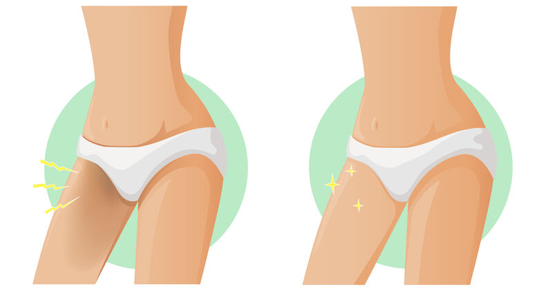 Eliminar las manchas oscuras de las piernas es posible si aplicas tratamientos efectivos.