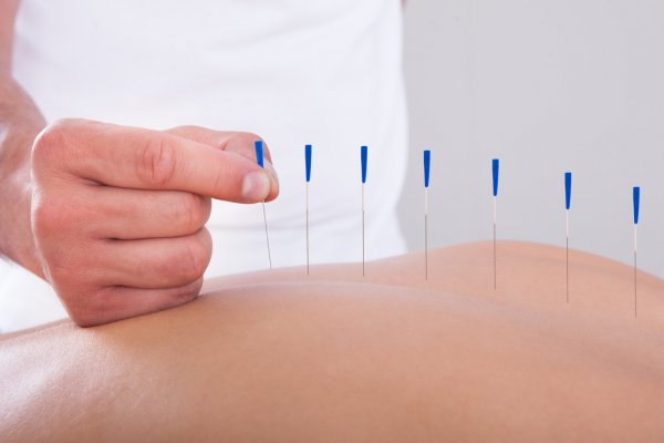 La acupuntura es un tratamiento súper efectivo para la ansiedad.