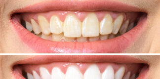 blanquear dientes con limon y sal