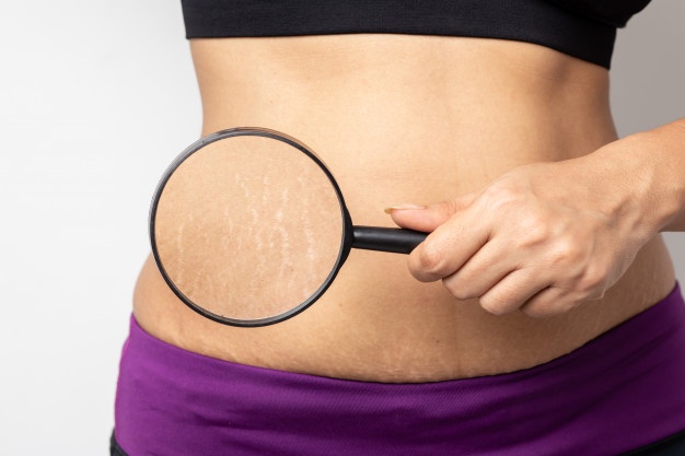 Cuerpo de mujer con una lupa para mirar sus estrías.