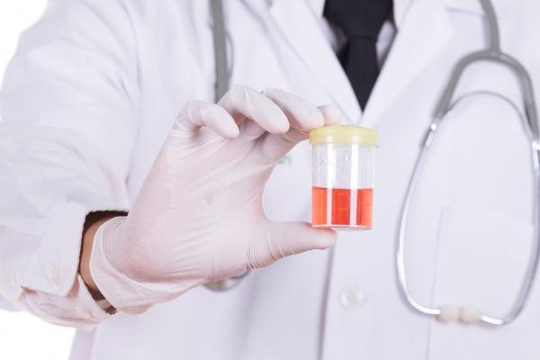 cuerpo de un médico sosteniendo un frasco de orina de color rojiza.