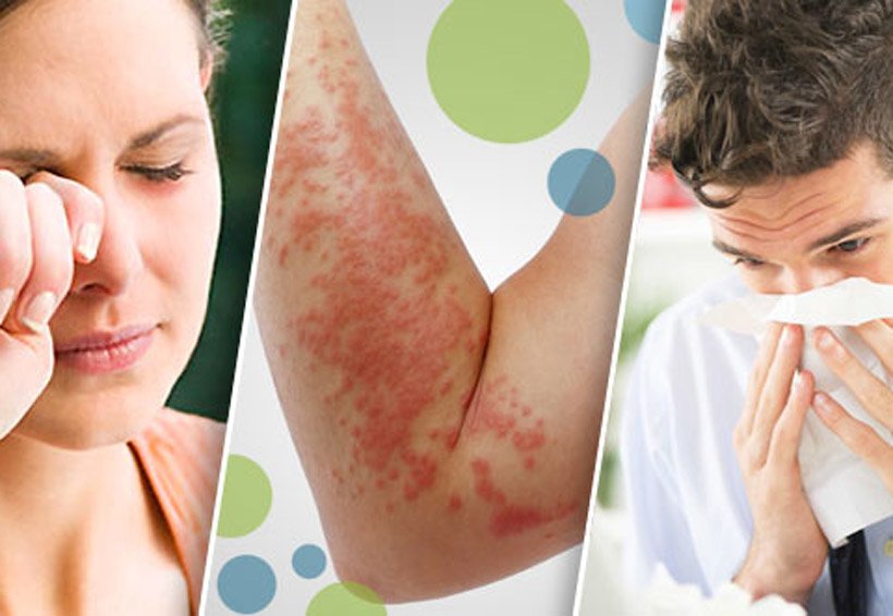 Las alergias extrañas muchas veces no se detectan como alergias por falta de conocimiento de la persona.